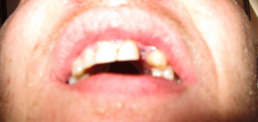 Before Implant
