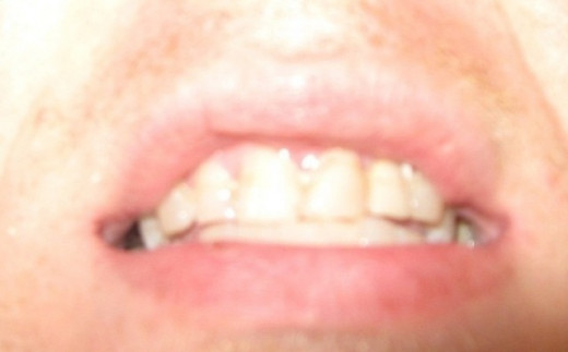 After Implant