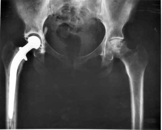 X-ray showing artificial right hip in place.