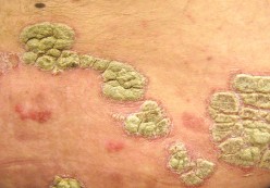 Psoriasis, Obesity, and Heart Disease