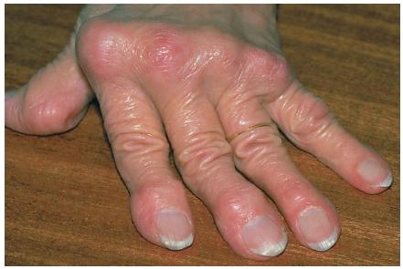 Psoriatic Arthritis is an aggressive and potentially destructive, inflammatory arthritis.