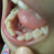 An Empty Space in Gum After Removing A Tooth An Empty Space in Gum After Removing A Tooth