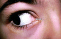 Lacrimal Caruncle