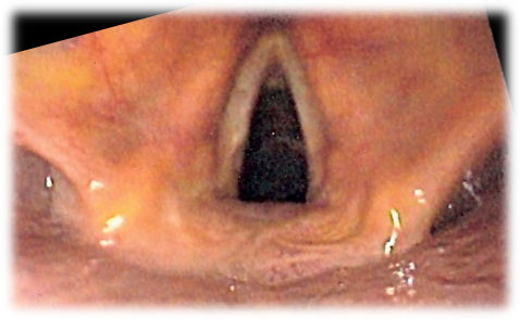 A functioning larynx (this person is breathing in and allowing air to pass freely through the vocal cords).
