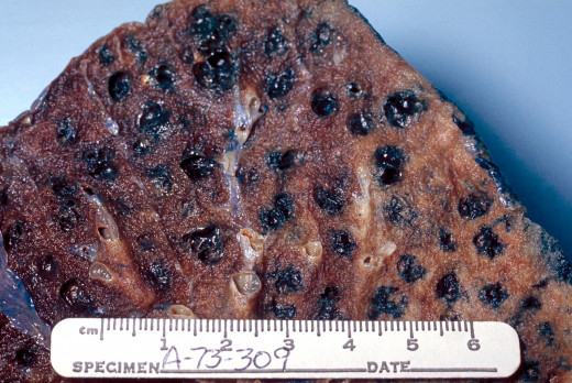 Gross pathology of lung showing centrilobular emphysema characteristic of smoking. Closeup of fixed, cut surface shows multiple cavities lined by heavy black carbon deposits.