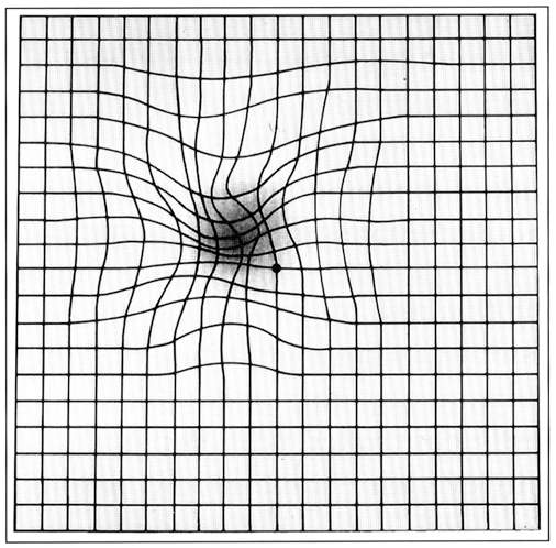 Amsler grid as it might appear to a person with macular degeneration