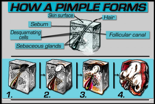 How a pimple forms, step by step.