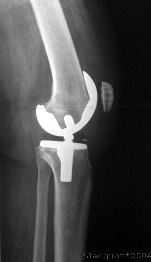 Xray showing a total knee arthroplasty.