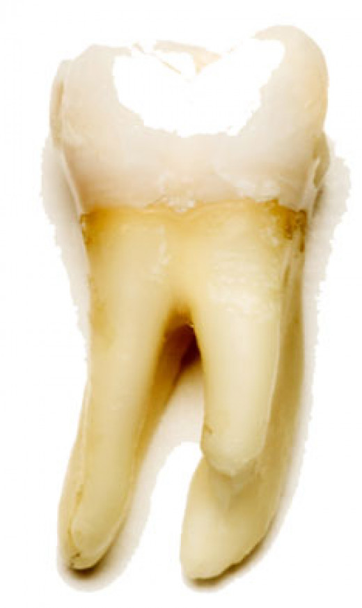 Temporary Emergency Cavity Toothache Relief Until Dentist Appointment hubpages