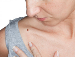 Melanoma: Signs and Pictures