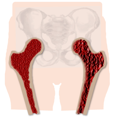 The bone on the left is normal whereas one on the right shows osteoporosis. 