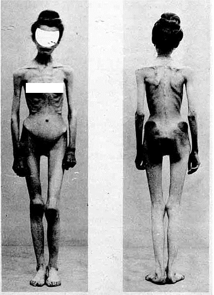 Anorexia in 1900