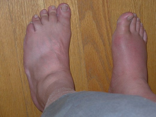 Right big toe, gout with advanced swelling. This condition is one of the most excrutiatingly painful!