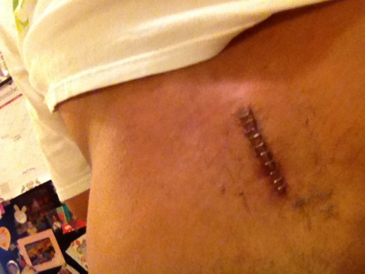 Photo of my lower back after about 2 weeks.