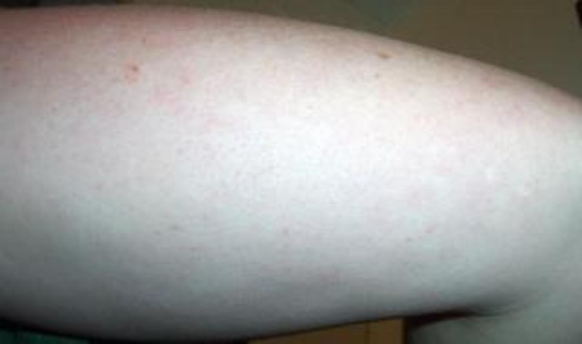 How To Get Rid Of Bumps On Arms Hubpages