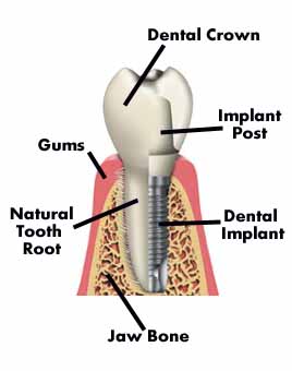 Tooth Implant after extraction