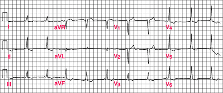 Classic WPW EKG