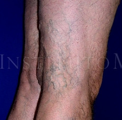 Signs of chronic venous insufficiency