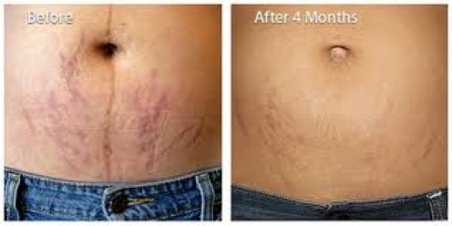 stretch mark removal cream before and after