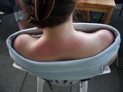 Although many people love having their shoulders worked on, sunburn is a good reason to ask your therapist to avoid the area.