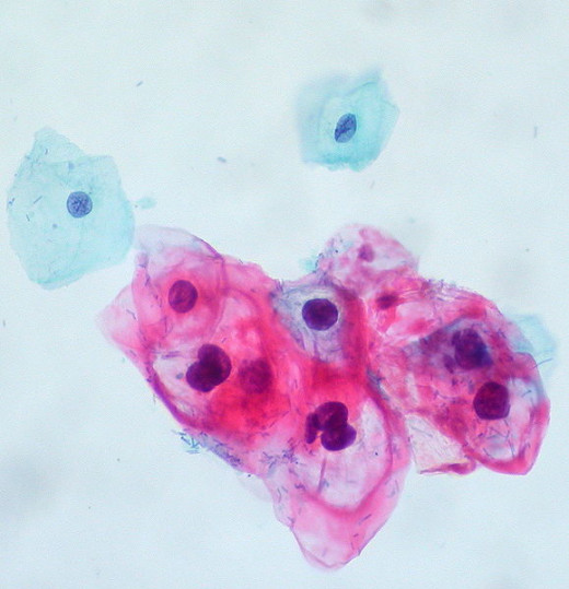 Cervical cells in stage CIN I infected with HPV, with two normal cells at the top. Source: Ed Uthman, Wikimedia Commons, CC BY-SA 2.0.