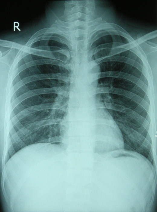 A lot more X-rays pass through air-filled structures (like lungs) which consequently 'blackens' the film more
