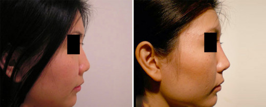 No Surgery Nose Job: Radiesse Cost and Before and After Photos 