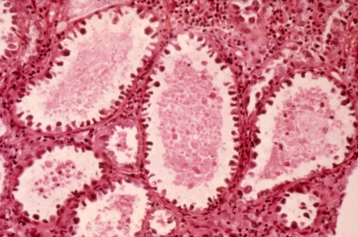 Cancer Cells of the Cervix