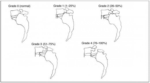 Meyerding Grading of Slippage Anterolisthesis