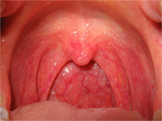 http://commons.wikimedia.org/wiki/File:Pharyngitis.jpg