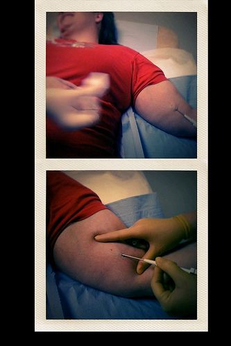 Pictures of a woman getting her birth control implanted.