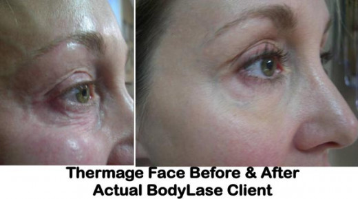 Thermage Face Treatment Before and After