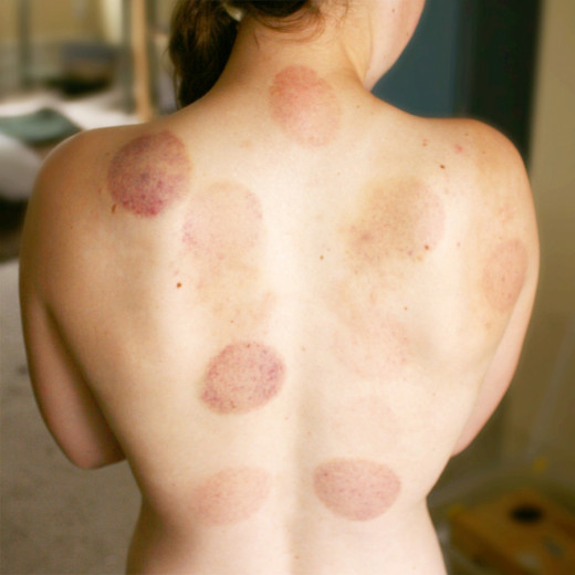Cupping marks