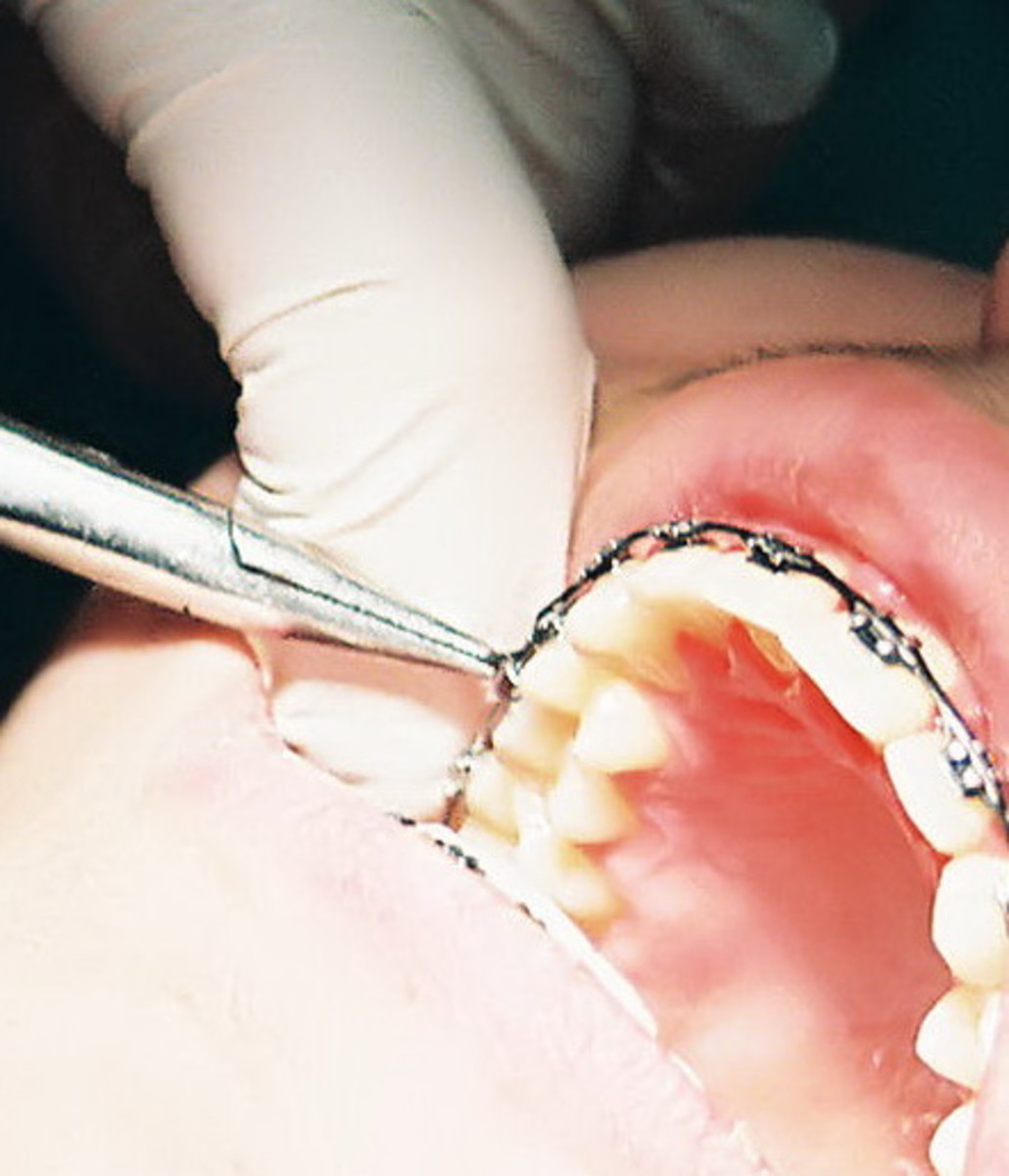 Getting braces on teeth
