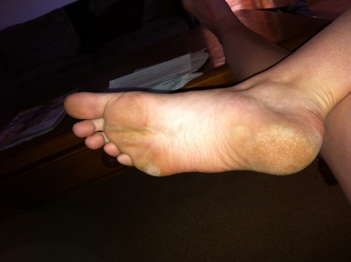 Calloused Feet 35