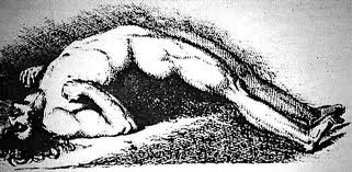 Opisthotonos: Note the arched back and heightened body