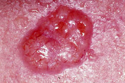 Basal cell skin cancer: This is the most common form of skin cancer. Note the irregular surface and borders.