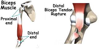A ruptrued tendon can be painful and uncomfortable