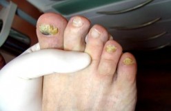 How to treat and cure nail fungus