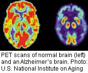 The brains of people with Alzheimer's show significant differences from those who do not have Alzheimer's