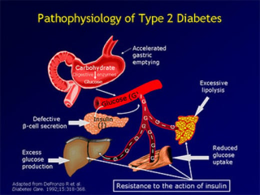 Take Pre diabetes Symptoms seriously:How to Reverse Pre diabetes ...