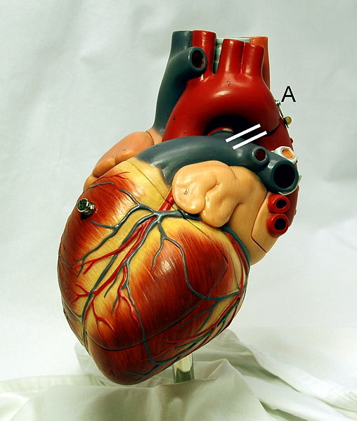 Photograph of a heart model, with position of a persistent ductus arteriosus drawn in between aorta and pulmonary artery.