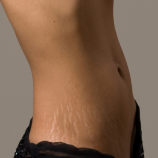 how-to-get-rid-of-stretch-marks-causes-prevention-treatments-of