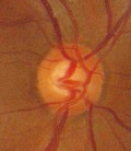 Definition of Ocular Hypertension