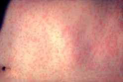 Measles and Rubella: Facts, Similarities, and Differences