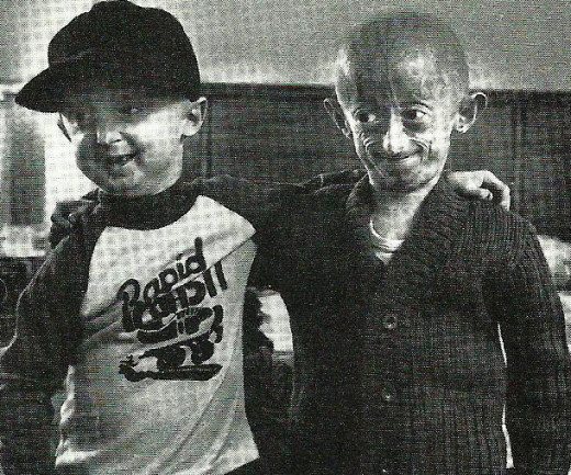 Premature Aging (Progeria) seen in boys