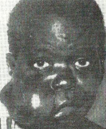 Child With Burkitt's Lymphoma