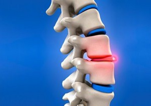 Slipped Disc and Acupuncture: A Personal Experience Slipped Disc and Acupuncture: A Personal Experience