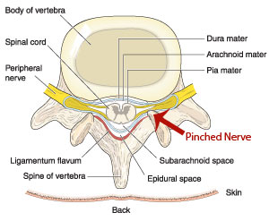 The Anatomy Of A Pinched Nerve in the Neck