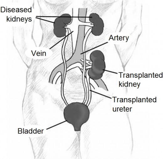 Renal transplantation is one of the most common organ transplants.